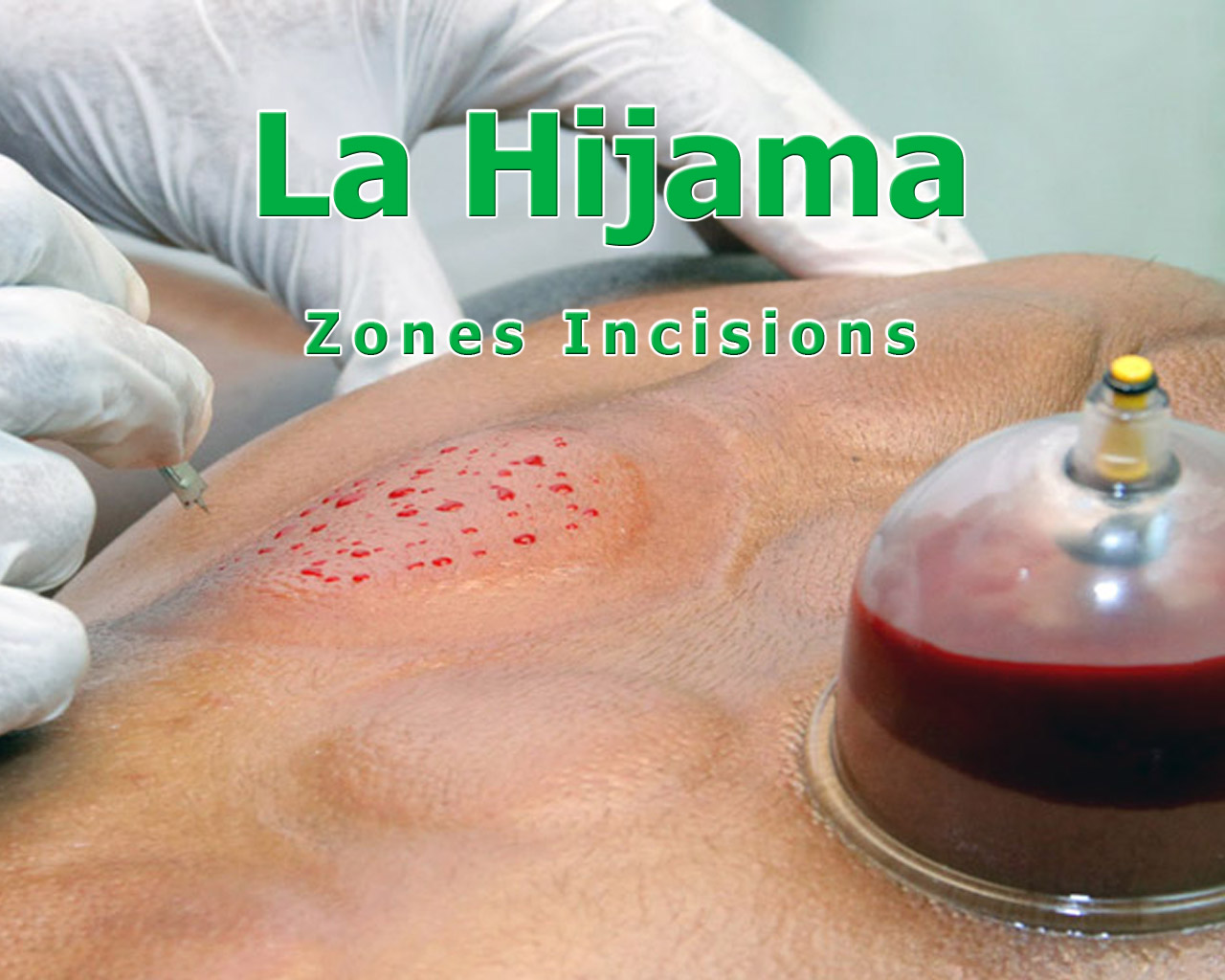 hijama zone incisions